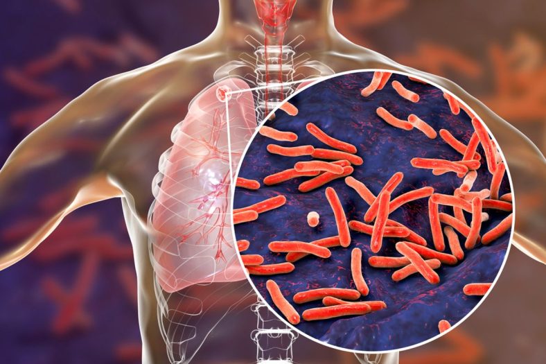 ilustrasi dari infeksi bakteri tuberkulosis