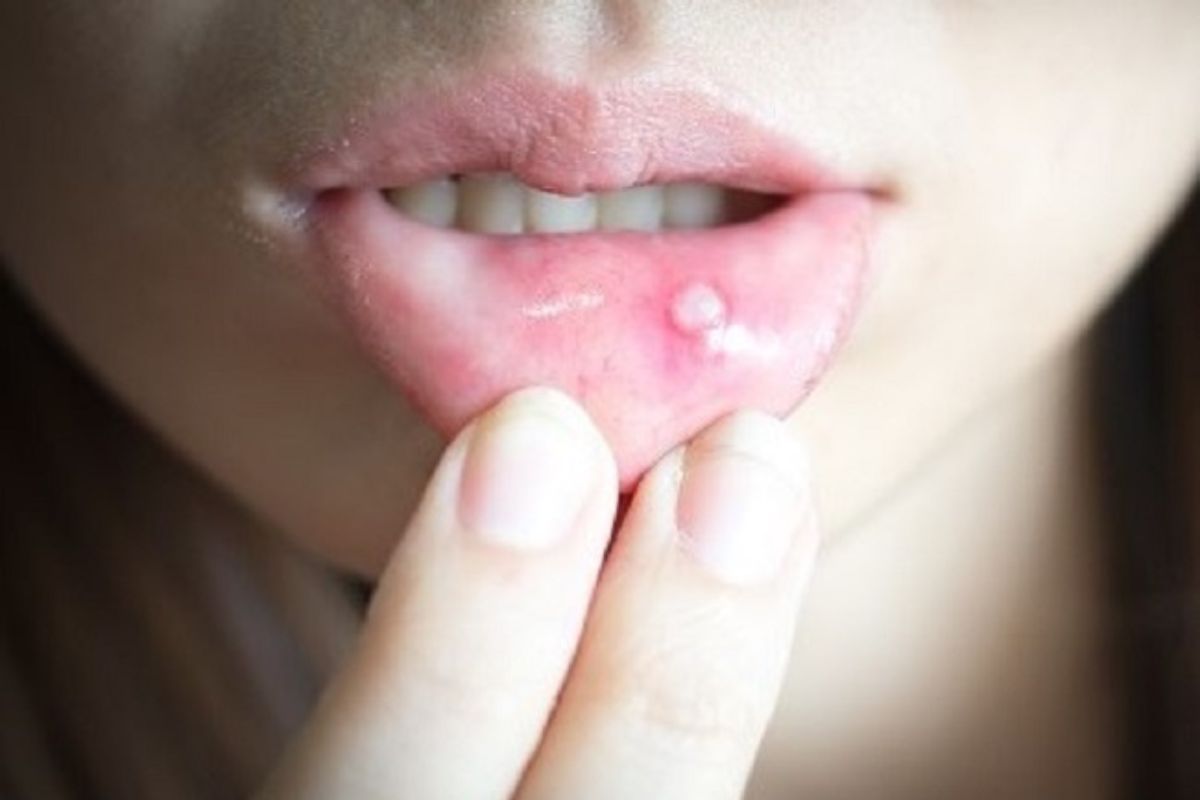 Sariawan_di_Bibir