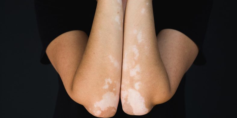 Vitiligo pada kulit