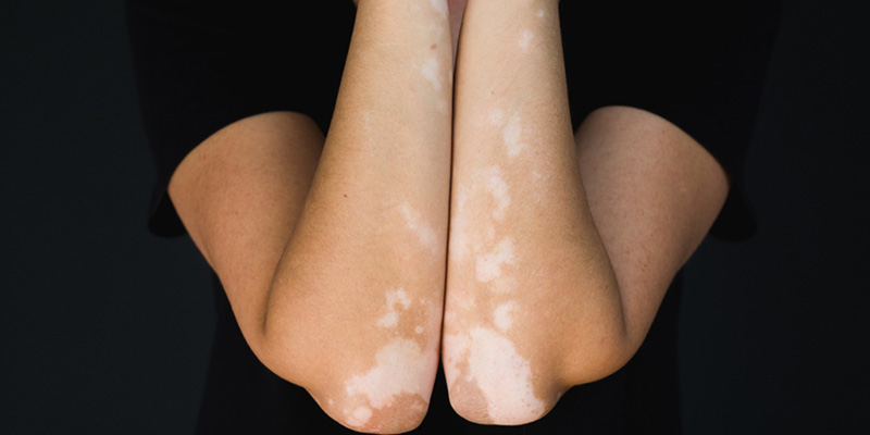 Vitiligo pada kulit